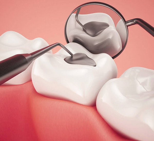 Trám răng thẩm mỹ tại Đà Nẵng - Giải pháp phục hồi răng hư tổn