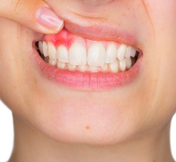 ĐIỀU TRỊ DỨT ĐIỂM VIÊM NƯỚU - NHA CHU