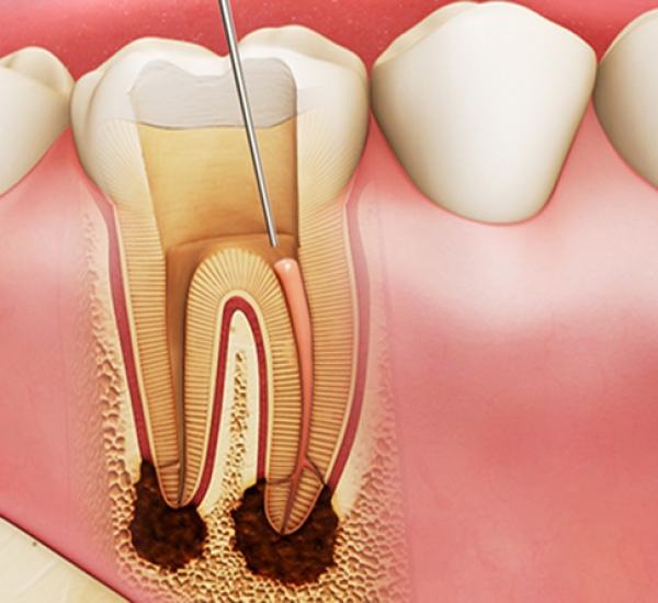 ĐIỀU TRỊ TỦY RĂNG KHÔNG ĐAU - CÔNG NGHỆ HIỆN ĐẠI